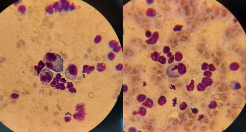 Врачам выделят 121 миллион рублей за раннее выявление рака