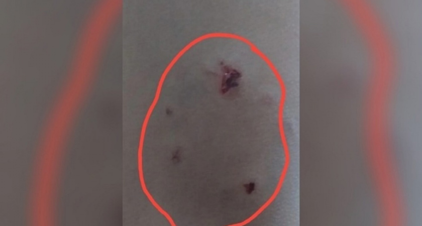 Прокуратура проверит нападение бездомных собак на школьника в Саратове