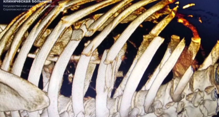 В Балаково врачи спасли женщину после 10 операций и месяца в реанимации