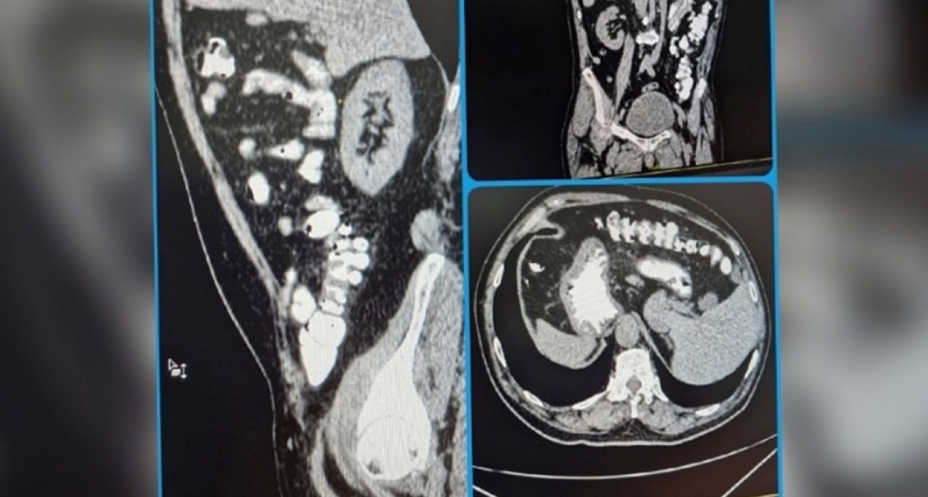 "Случайная находка": житель Саратова узнал о зеркальном расположении всех органов во время КТ