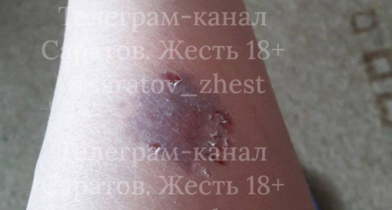 "Вышла вынести мусор и попала в ад": стая собак прокусила ногу саратовчанке у дома на Лунной