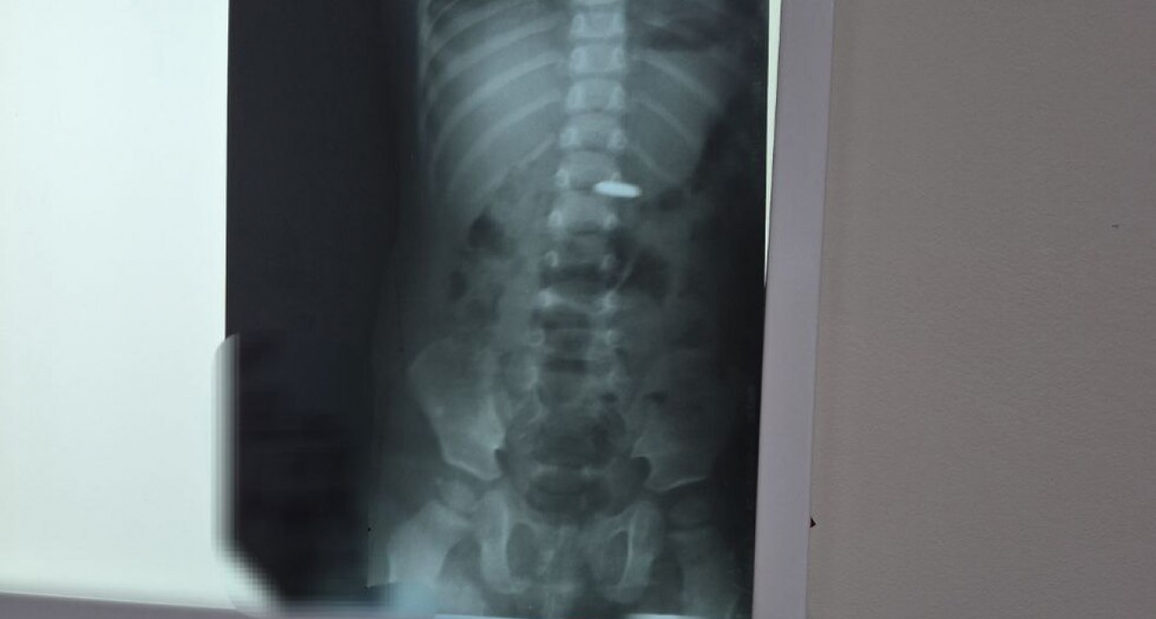 "Мгновенный урон за 2,5 часа": врачи Балакова экстренно спасли годовалого ребенка от смертельной батарейки