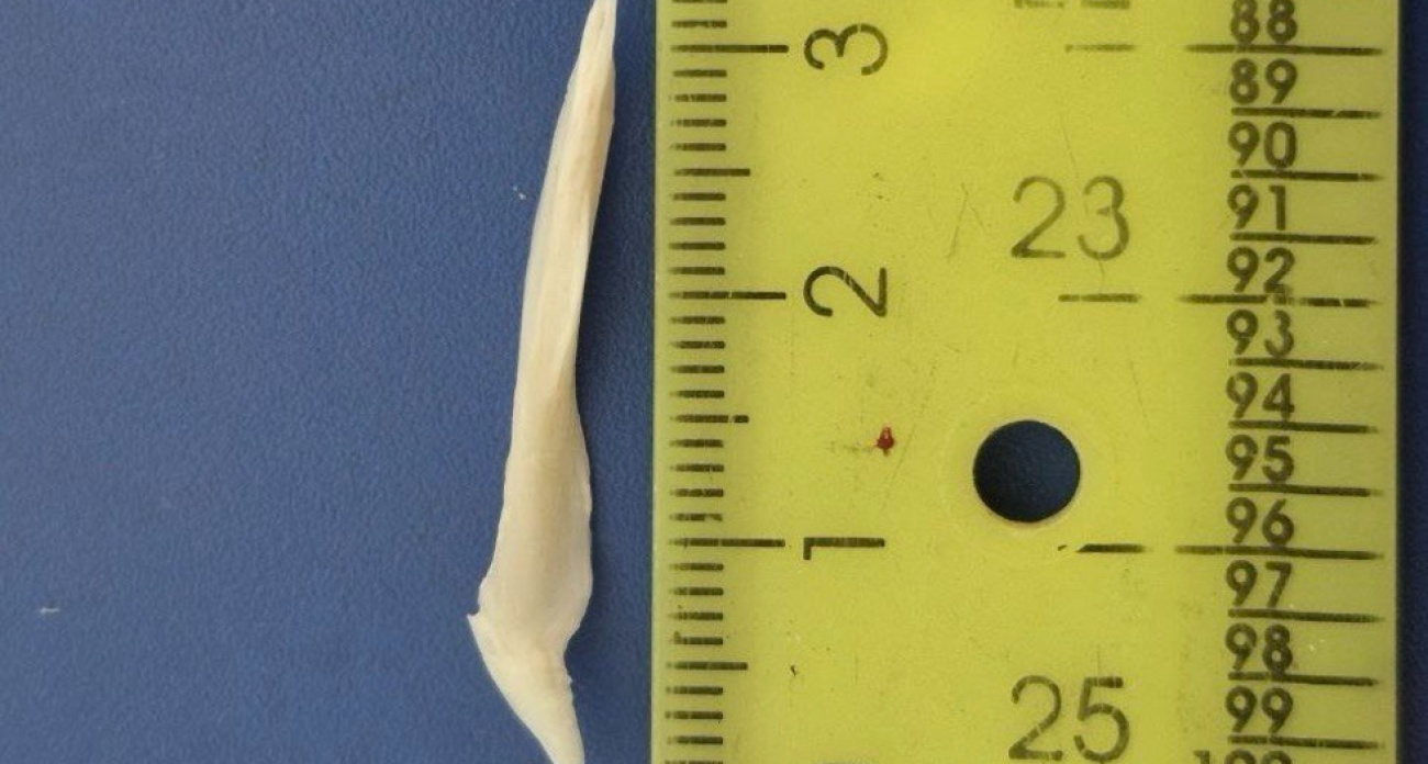 В Балаково мужчина проглотил 3-сантиметровую рыбью кость: она встала "распоркой" в пищеводе