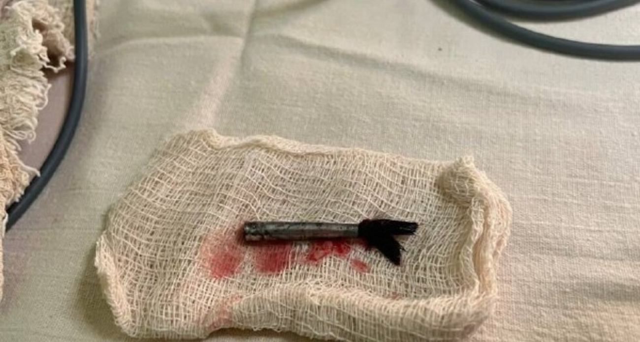 Две рыбные кости и железный наконечник у сонной артерии: врачи спасли детей от смертельной опасности