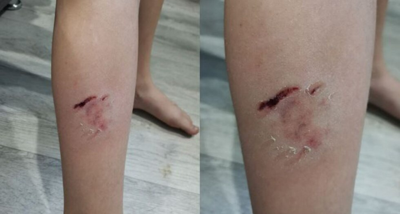 Школьницу покусала собака на 5-м Динамовском: мать годами жаловалась на стаи, но власти бездействовали