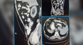 "Случайная находка": житель Саратова узнал о зеркальном расположении всех органов во время КТ