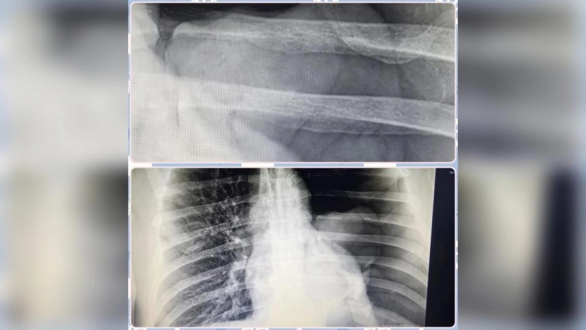 Четверо мужчин за несколько дней: в Балакове спасают пострадавших от падений с лестниц